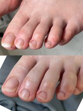 カラー(calla)/足の爪長過ぎると危険