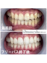 ホワイトニングサロン 京都烏丸店/ホワイトニング施術例