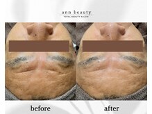 アン ビューティー(ann beauty)/施術1回【症例写真】50代男性
