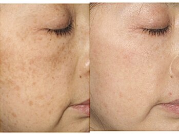 パルファンカルム 駅西本町店/手強いシミにお悩みの方へ!