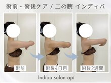 アピ(api)/症例写真【インディバ】