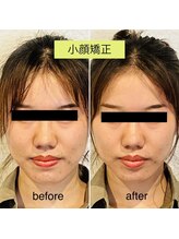 チキバン美容鍼灸整体サロン 心斎橋店/小顔矯正