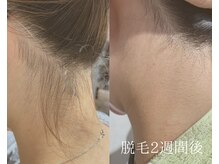 ランプシー(Lampsi)/首周りスッキリ！うなじ美肌脱毛