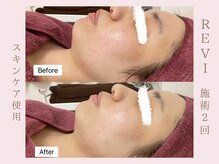 ルア(LuA.)/くすみ改善