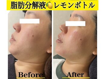 ブレア(Blair)/深層リフト小顔フェイシャル