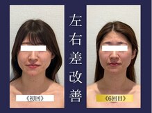 エレミュー 烏丸(Elemue.)/《20代》左右の歪み改善