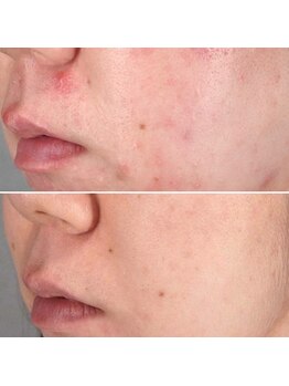 ブライズ(BRISE)/ニキビケア