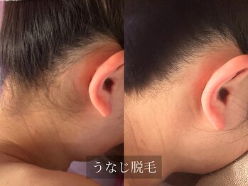 アルム(Arum)/うなじ脱毛