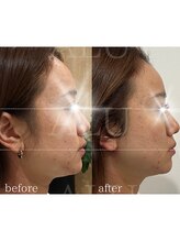 アルフォービューティー 難波店(ALU for beauty)/オンダリフト症例