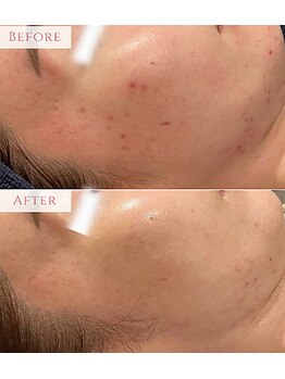 アンドニューリー(&NEWLY)/LDM水玉リフティング