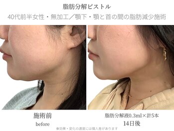 サボラミ(sabor A Mi)/顎下と首間のボリュームも対応◎