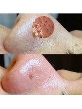 クレビア(CREVIA)/二刀流エクストラクション