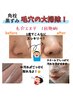 【毛穴エステ】角栓、黒ずみ、いちご鼻、毛穴詰まりをごっそり大掃除¥10900→