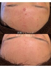 エル(Elle)/剥けないハーブ4回