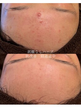 エル(Elle)/剥けないハーブ4回