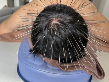 テイクケア(TAKEケア)/ルート鍼