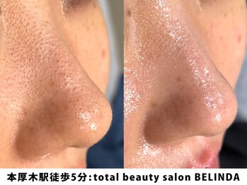 ベリンダ(BELINDA)/毛穴洗浄×セルマンピーリング