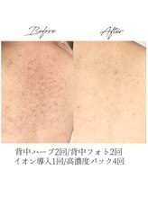 ビズビズ 天王寺店(bisebise)/〈症例〉背中ニキビ改善