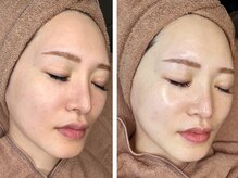 ルシール 仙台店(lucir)/ニキビ・シミケア・ハリツヤ特化