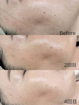 エクラ(eclat)/ハリ、ツヤ、キメ!2週間1回施術