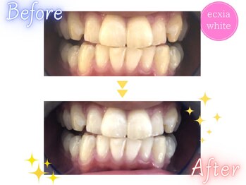 エクシアホワイト 広島袋町店/ホワイトニングビフォーアフター