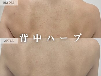 レヴェリー 心斎橋店(REVERIE)/背中ハーブピーリング４回目