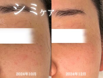 アールエーサロン 恵比寿 広尾(Ra salon)/シミ改善