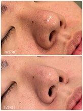 クラン 森ノ宮店(Clan)/ハーブピーリング　20代男性