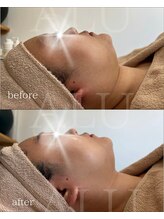 アルフォービューティー 難波店(ALU for beauty)/オンダリフト症例
