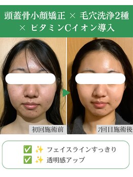 ブプラ 代々木上原店(BUPURA)/小顔×肌質改善