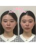 【学割U24】【モニター募集】激変超人気の小顔矯正コース♪￥12000→￥3000