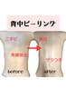 美白ピーリング★背中・二の腕・肘の角質除去！剥離なし〇