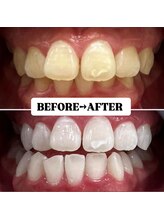 ホワイトニングサロン 豊中/Before&After美白ホワイトニング