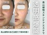 【シミ・くすみ撃退】1回で実感！小顔×美白ケア　70分¥3980 
