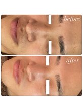 ラディエンス 多治見店/メンズ！リアボーテ毛穴エステ