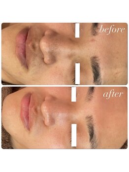 ラディエンス 多治見店/メンズ！リアボーテ毛穴エステ