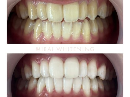ミライホワイトニング(MIRAI WHITENING)の写真