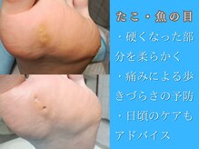 皮膚が硬く厚くなると痛みが…当店で改善ケアをしましょう！