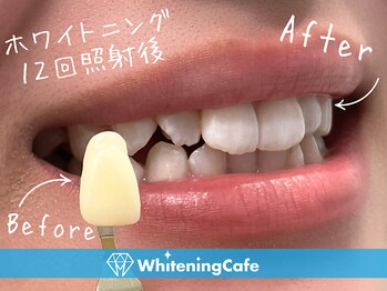 ホワイトニングカフェ 仙台店(WhiteningCafe)/☆歯のホワイトニング施術写真☆