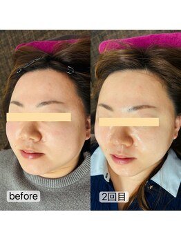 トゥインクル(Twinkle)/ツヤツヤ、スッキリ♪