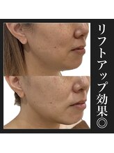 リベルテ 岡山(liberte)/カーボキシー炭酸パック小顔術