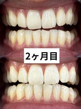 エクシアホワイトニング 京都四条店 2ヶ月目 歯の変化