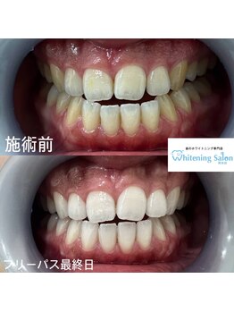 ホワイトニングサロン 熊本店/熊本セルフホワイトニング