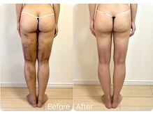 慧花(keika)/インディバ美容施術後ケア