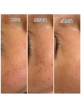 美肌工房 エステサロン上迫/おシミケア☆嬉しい報告続々★