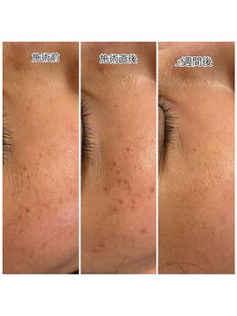 美肌工房 エステサロン上迫/おシミケア☆嬉しい報告続々★