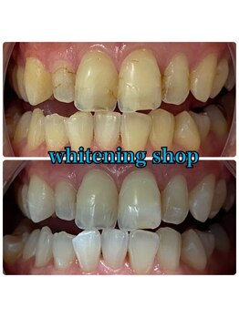 ホワイトニングショップ 三田店/before after