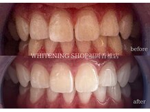 ホワイトニングショップ 福岡香椎店/美容ホワイトニングbefore after
