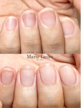 マリーロール 梅田店(Marie Laure)/自爪育成/深爪矯正/ネイルケア