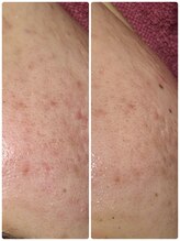 ビマリア(美-MARIA)/ハーブピーリング１回